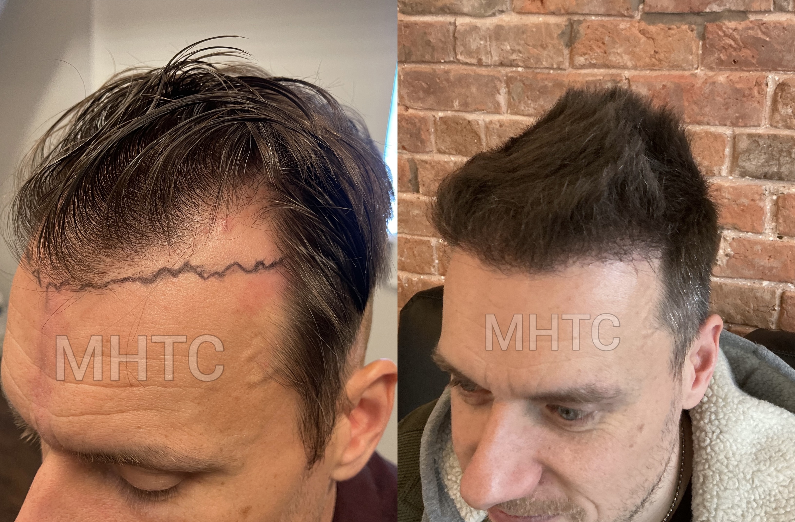 Feathered hairline — progress view